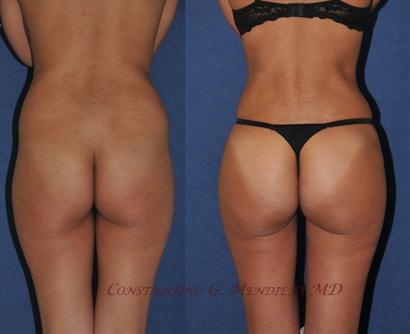 Fat Transfer & Brazilian Butt Lift before-and-after photo — 4Beauty Aesthetic Institute