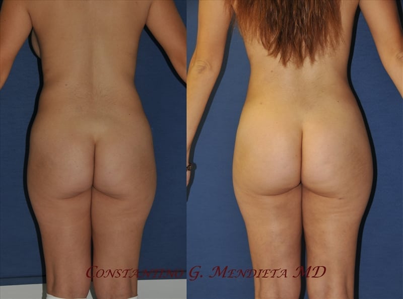 Fat Transfer & Brazilian Butt Lift before-and-after photo — 4Beauty Aesthetic Institute