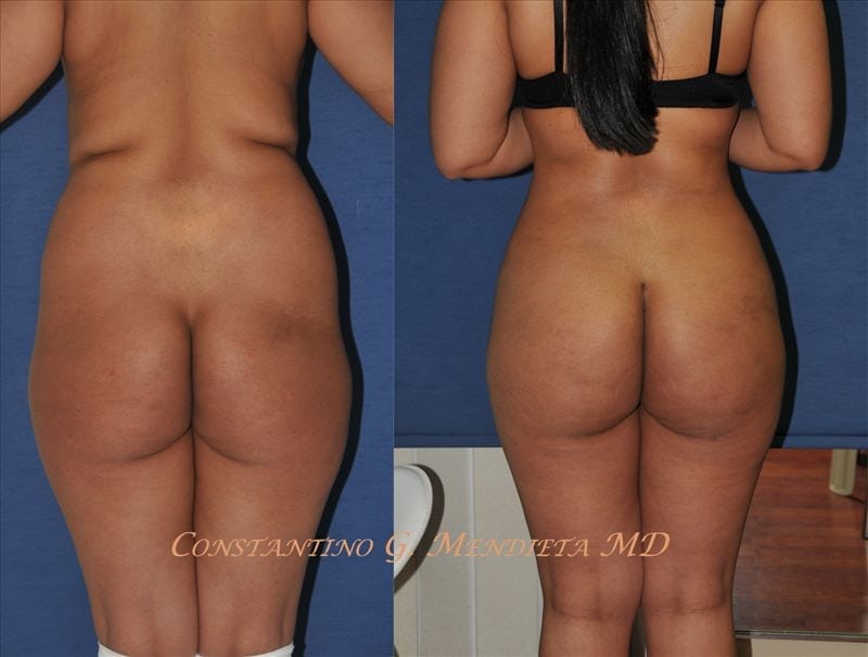 Fat Transfer & Brazilian Butt Lift before-and-after photo — 4Beauty Aesthetic Institute