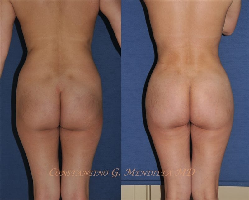 Fat Transfer & Brazilian Butt Lift before-and-after photo — 4Beauty Aesthetic Institute