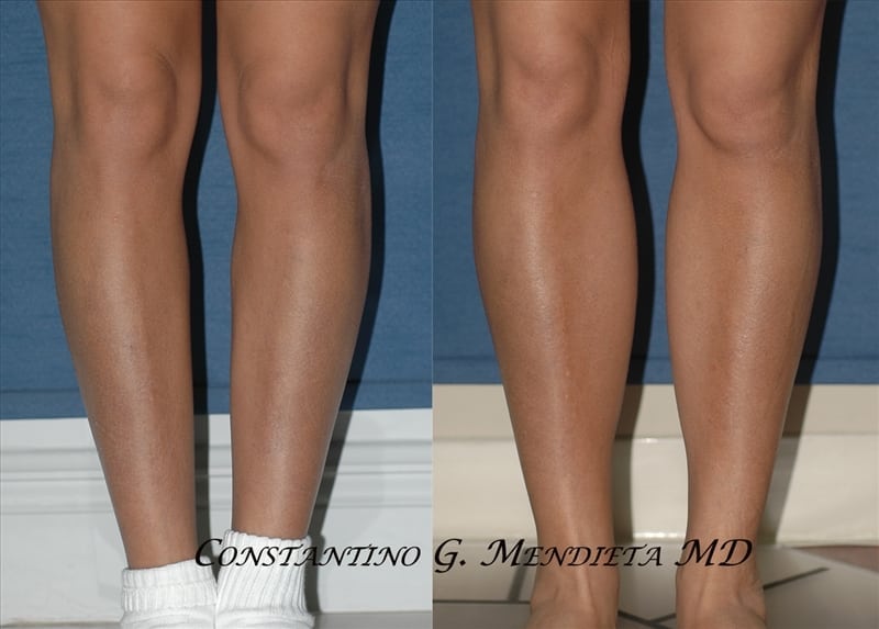Calf Implants before-and-after photo — 4Beauty Aesthetic Institute