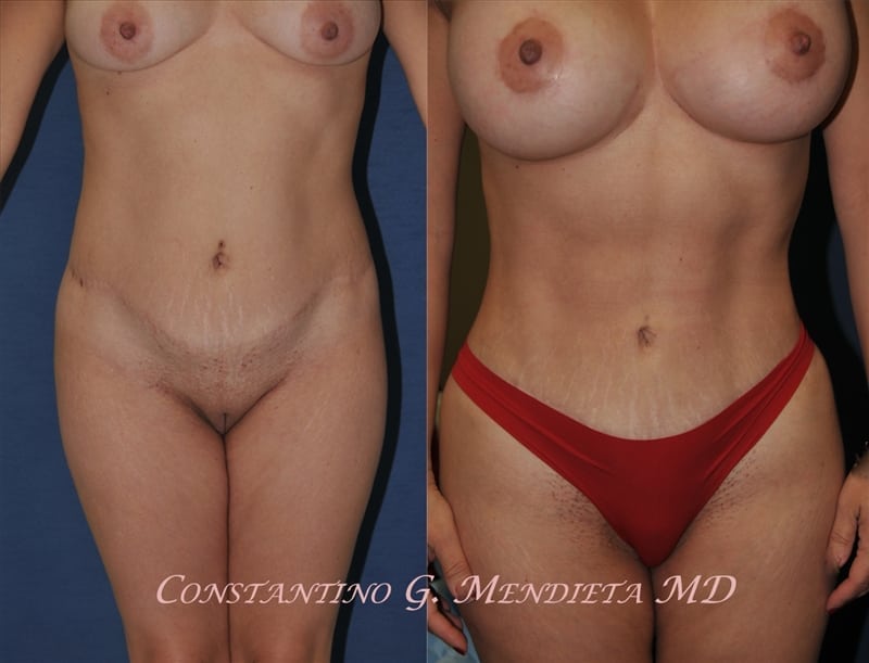 Liposuction before-and-after photo — 4Beauty Aesthetic Institute