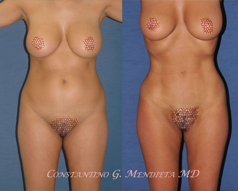 Liposuction before-and-after photo — 4Beauty Aesthetic Institute