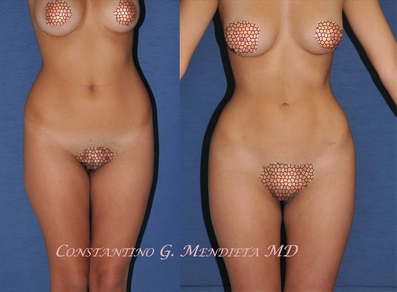 Liposuction before-and-after photo — 4Beauty Aesthetic Institute