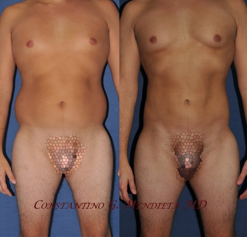 Liposuction before-and-after photo — 4Beauty Aesthetic Institute
