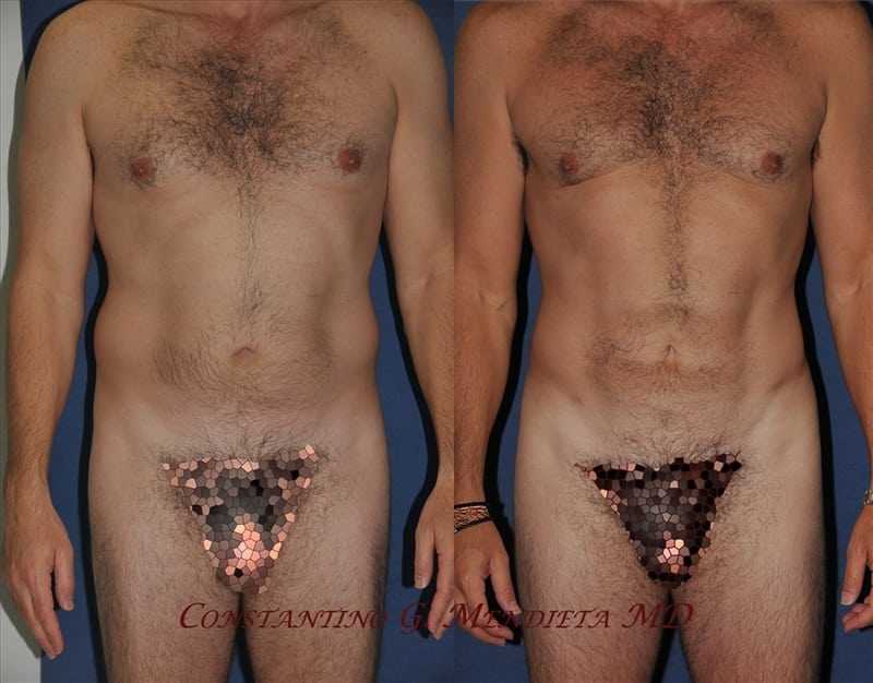 Liposuction before-and-after photo — 4Beauty Aesthetic Institute
