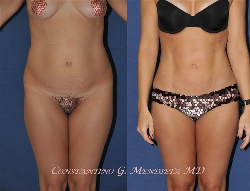 Liposuction before-and-after photo — 4Beauty Aesthetic Institute