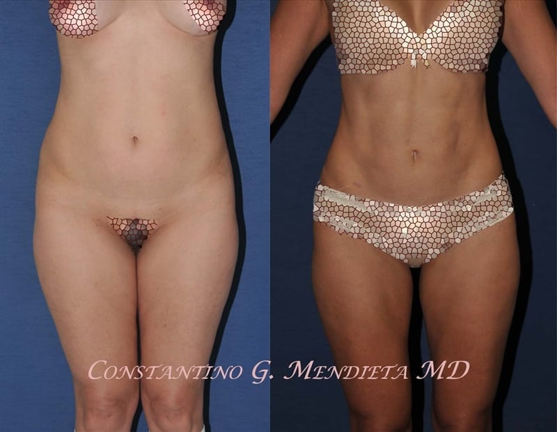 Liposuction before-and-after photo — 4Beauty Aesthetic Institute