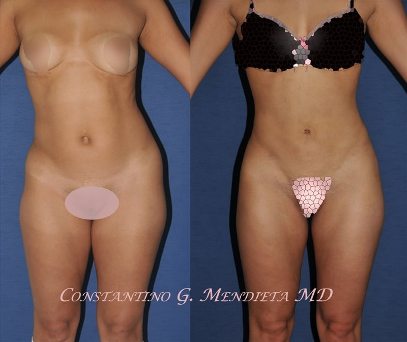 Liposuction before-and-after photo — 4Beauty Aesthetic Institute
