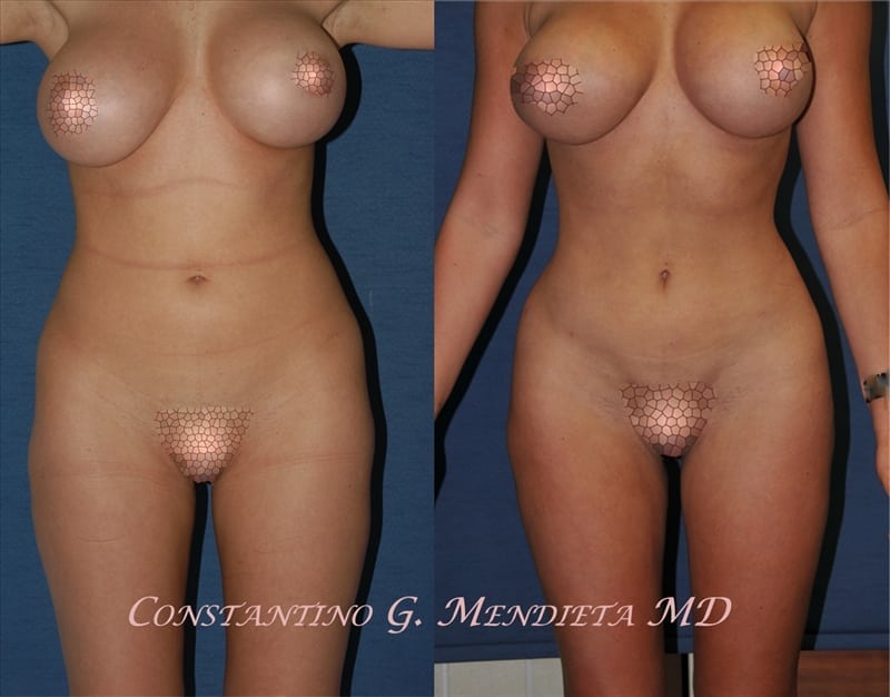 Liposuction before-and-after photo — 4Beauty Aesthetic Institute