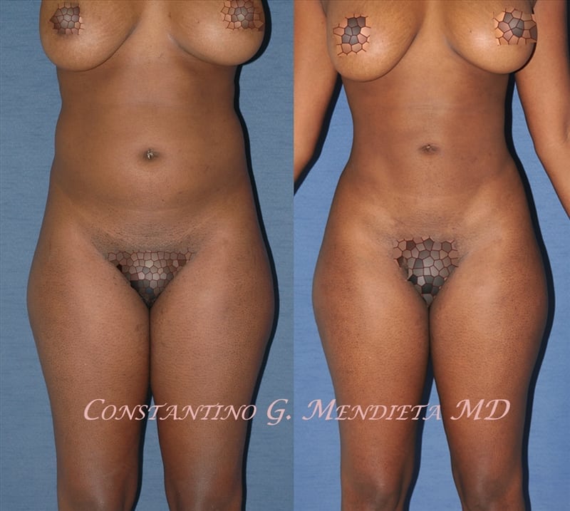 Liposuction before-and-after photo — 4Beauty Aesthetic Institute