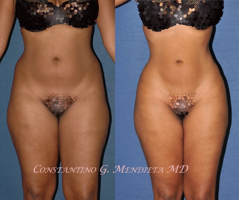 Liposuction before-and-after photo — 4Beauty Aesthetic Institute
