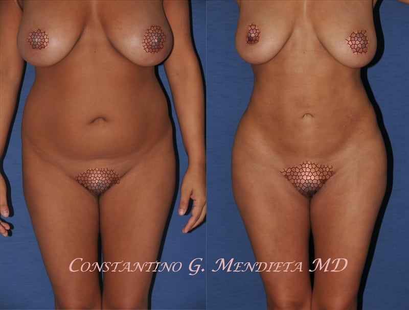 Liposuction before-and-after photo — 4Beauty Aesthetic Institute