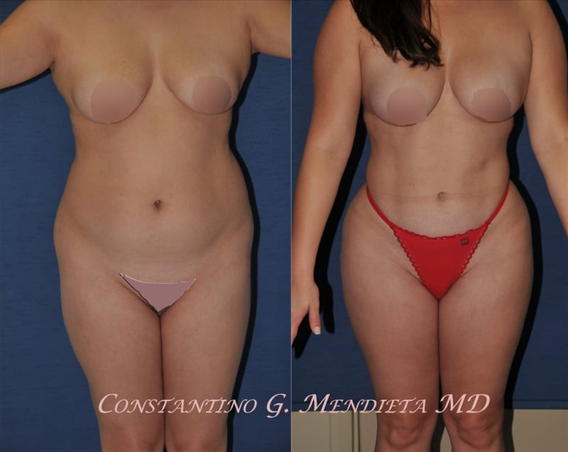 Liposuction before-and-after photo — 4Beauty Aesthetic Institute
