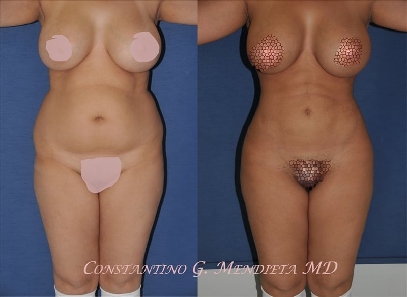 Liposuction before-and-after photo — 4Beauty Aesthetic Institute