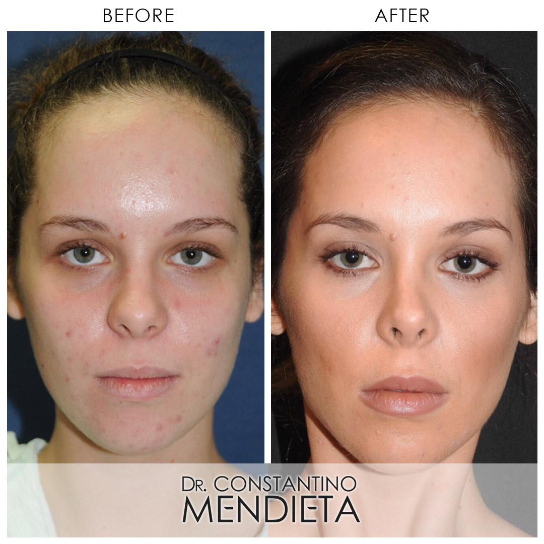Facial Contouring before-and-after photo — 4Beauty Aesthetic Institute