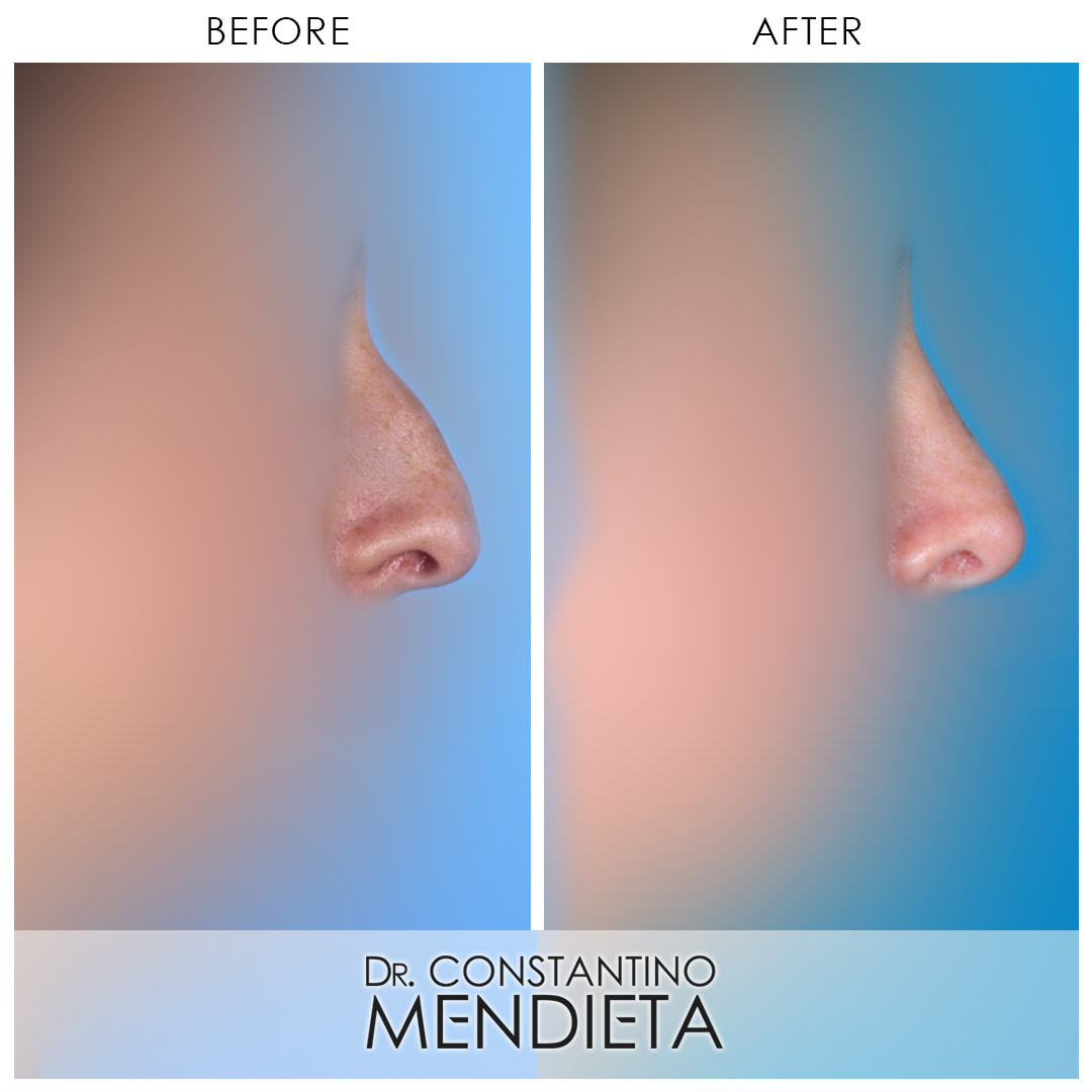 Rhinoplasty before-and-after photo — 4Beauty Aesthetic Institute
