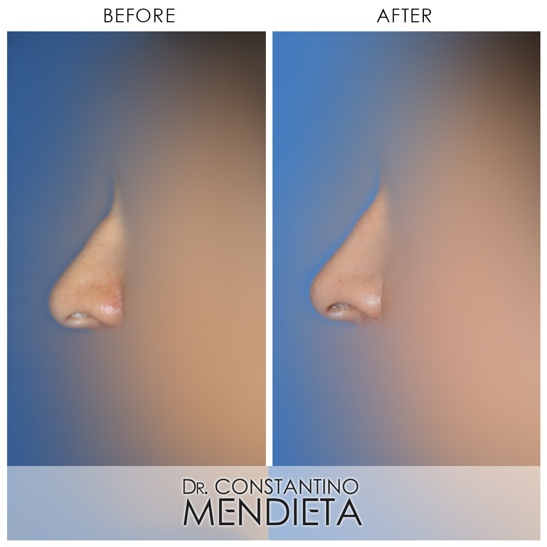 Rhinoplasty before-and-after photo — 4Beauty Aesthetic Institute