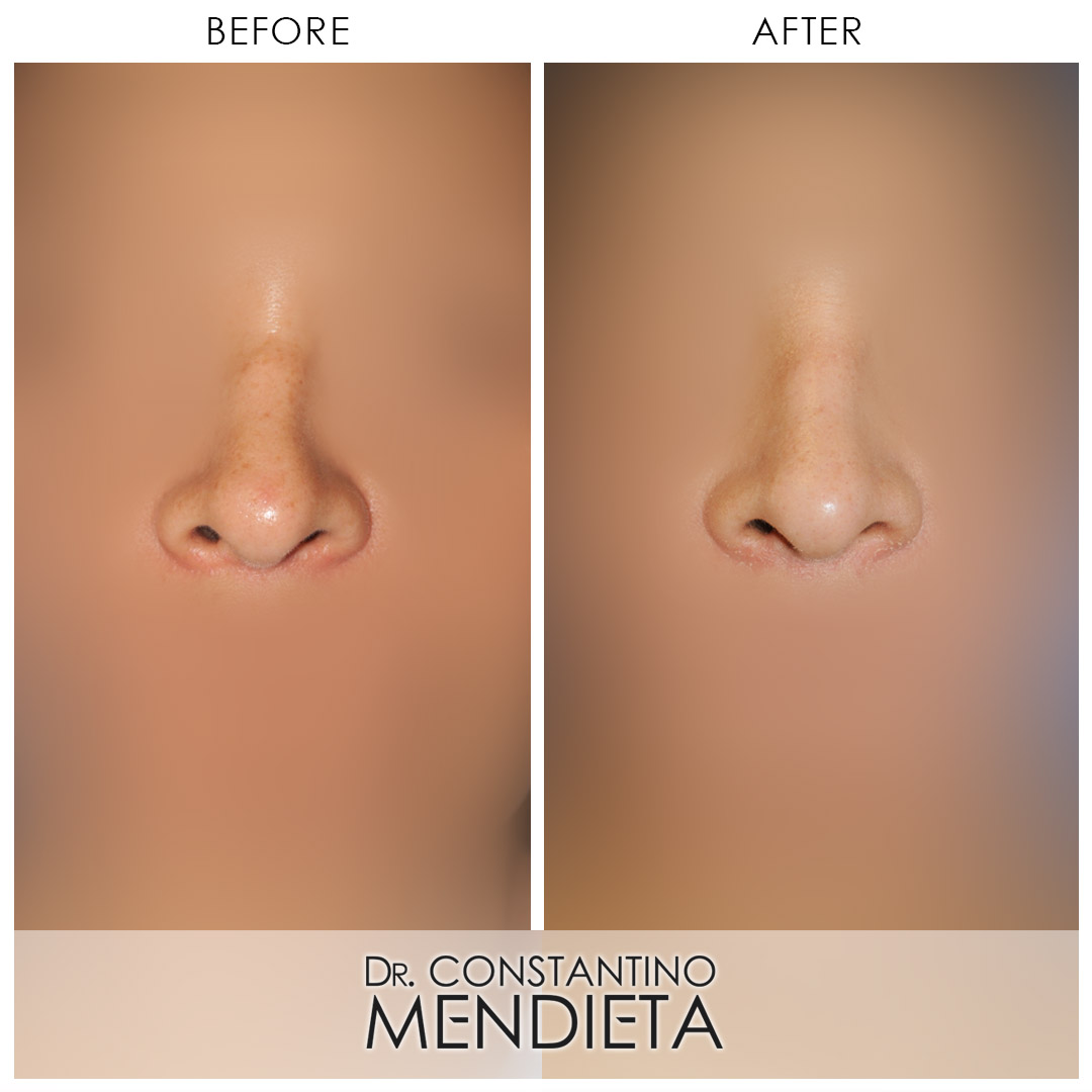 Rhinoplasty before-and-after photo — 4Beauty Aesthetic Institute