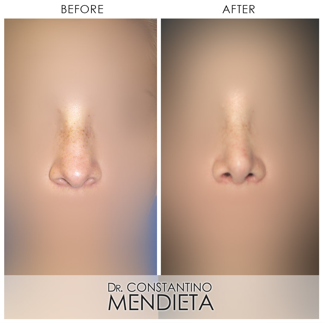Rhinoplasty before-and-after photo — 4Beauty Aesthetic Institute