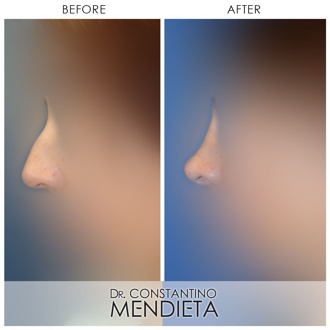 Rhinoplasty before-and-after photo — 4Beauty Aesthetic Institute