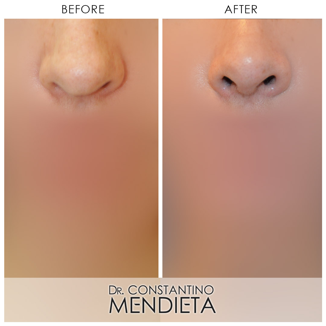 Rhinoplasty before-and-after photo — 4Beauty Aesthetic Institute