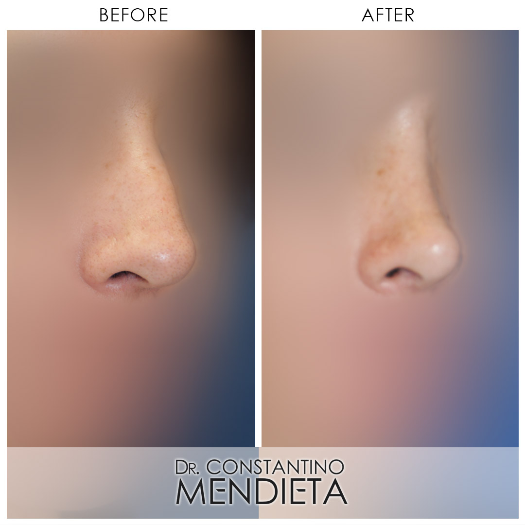 Rhinoplasty before-and-after photo — 4Beauty Aesthetic Institute