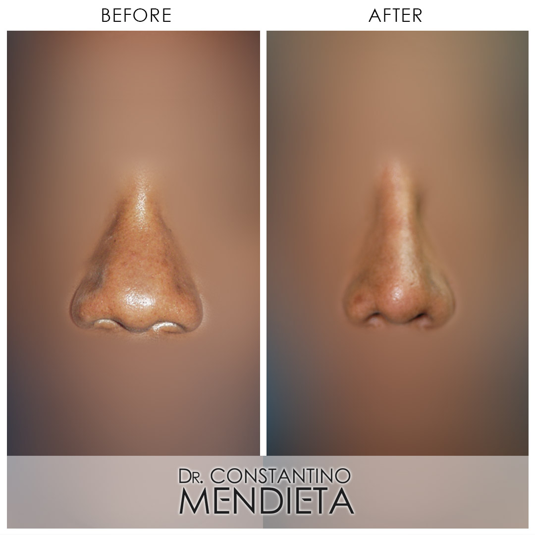 Rhinoplasty before-and-after photo — 4Beauty Aesthetic Institute