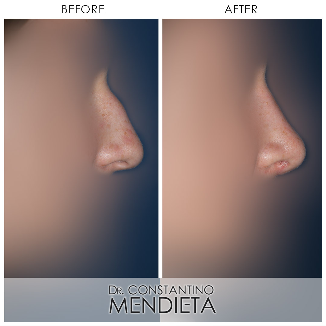 Rhinoplasty before-and-after photo — 4Beauty Aesthetic Institute