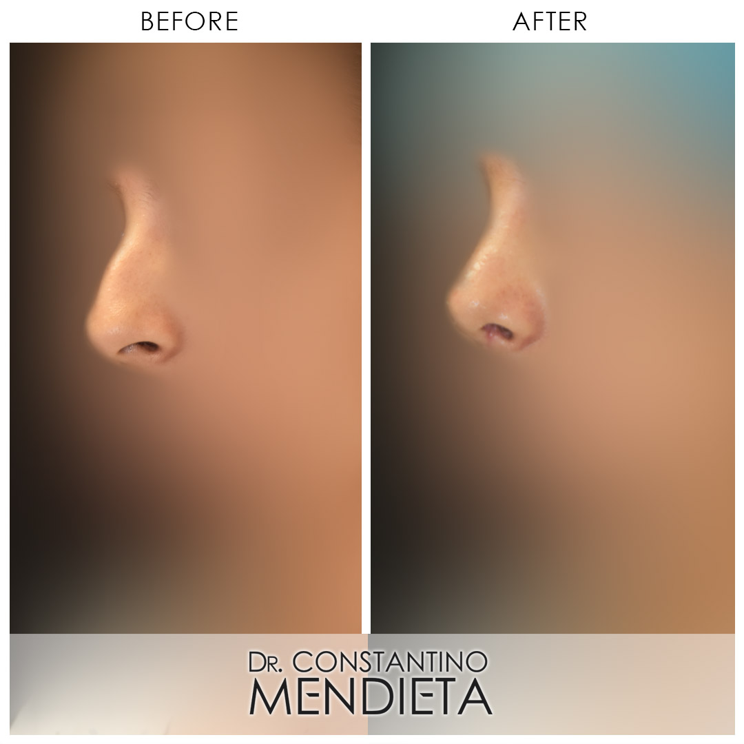 Rhinoplasty before-and-after photo — 4Beauty Aesthetic Institute