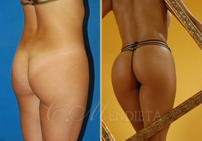 Miami-Thong-Lift-by-Dr-Mendieta