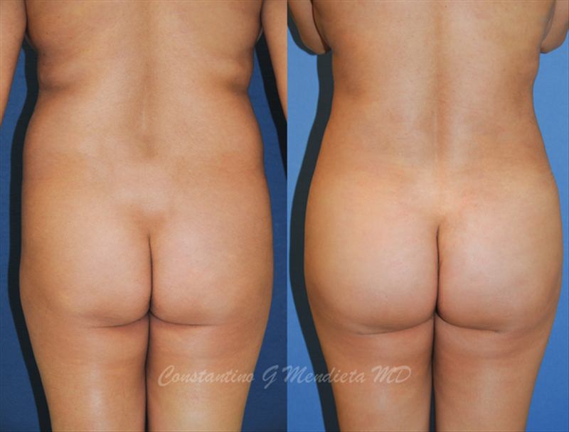 Fat Transfer & Brazilian Butt Lift before-and-after photo — 4Beauty Aesthetic Institute
