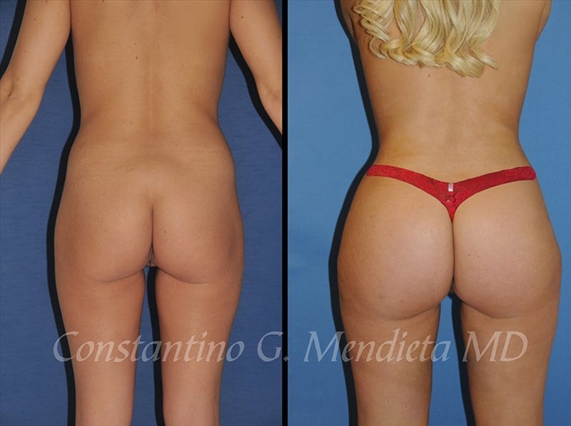 Fat Transfer & Brazilian Butt Lift before-and-after photo — 4Beauty Aesthetic Institute