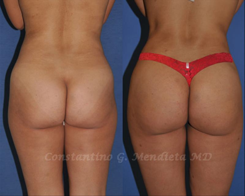 Fat Transfer & Brazilian Butt Lift before-and-after photo — 4Beauty Aesthetic Institute