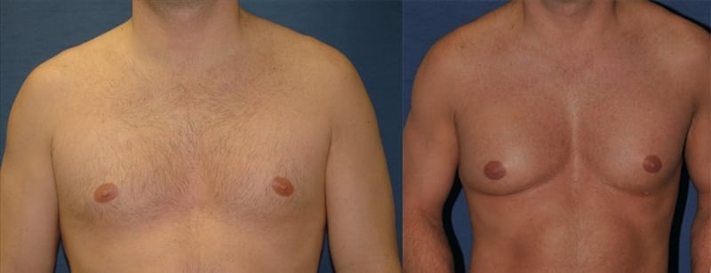 Before and after butt augmentation example 1