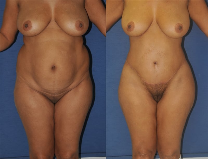 Before and after butt augmentation example 1