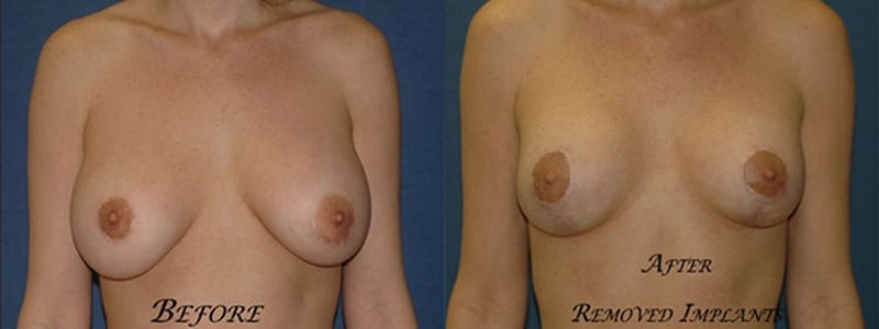 Before and After Image