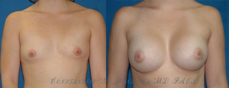 Before and After Image