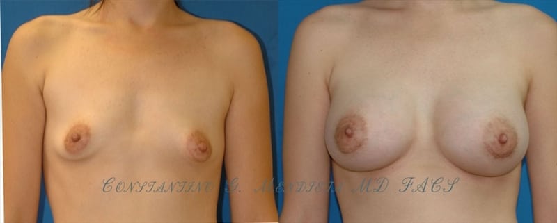 Before and After Image
