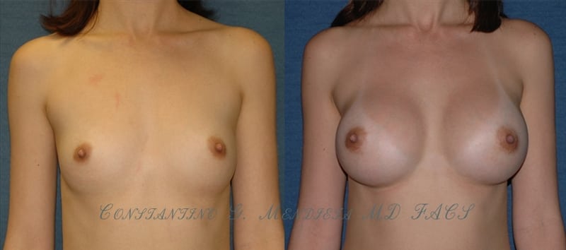 Before and After Image