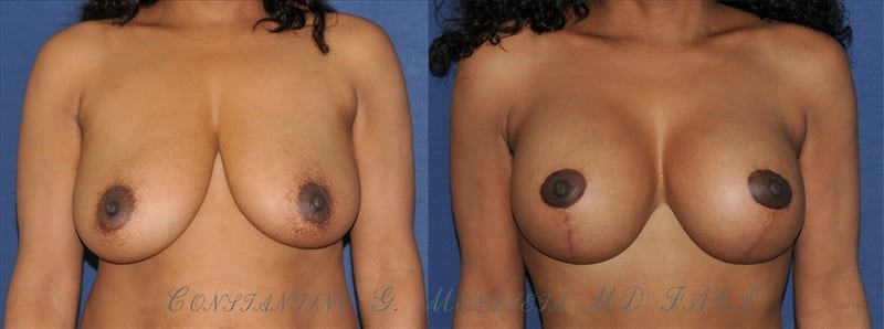 Before and After Image