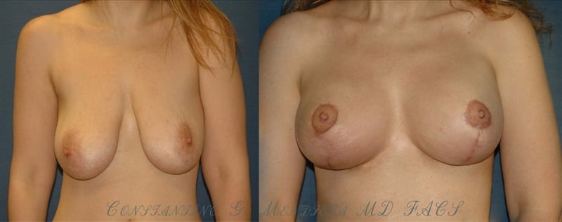 Before and After Image