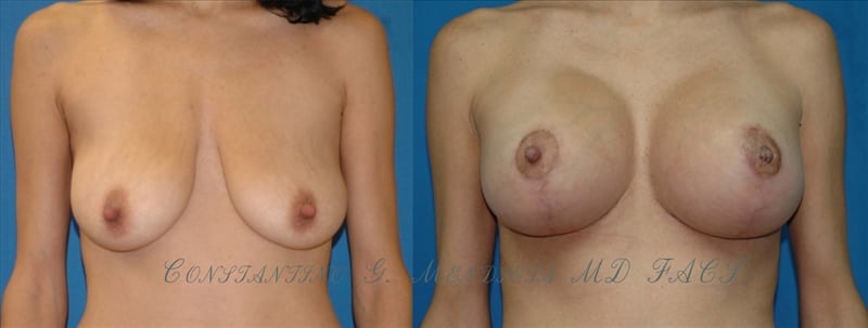 Before and After Image