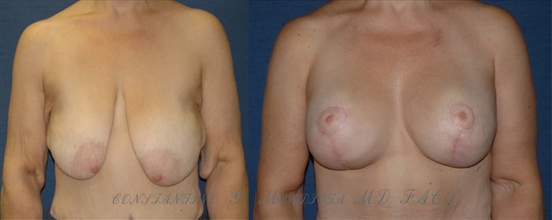 Before and After Image